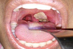 A case of Diphtheria Infection