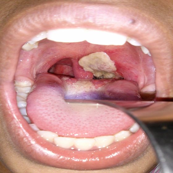 A case of Diphtheria Infection