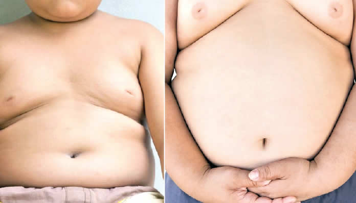 Children living with obesity lament