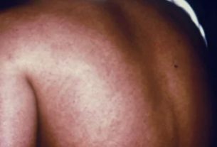 A woman with Marburg virus infection has a rash on her back